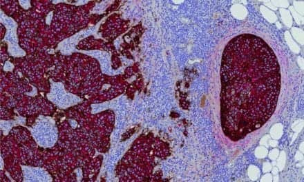 Roche Launches 2 Digital Pathology Image Analysis Algorithms for Precision Breast Cancer Diagnosis