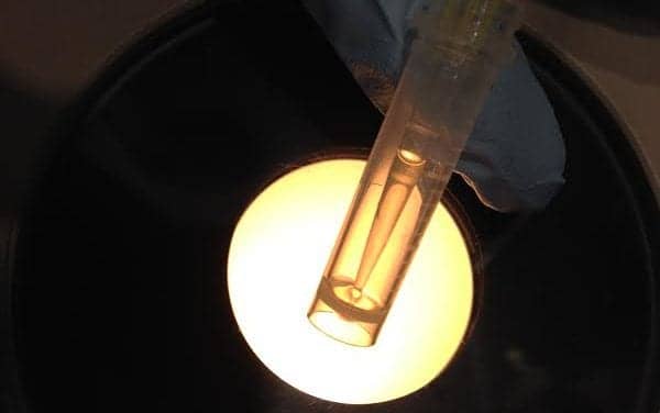 Test Integrates Analysis of DNA and Clinical Features of Pancreatic Cysts