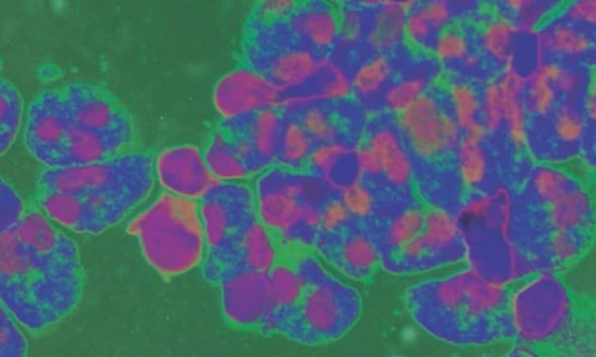 Fungal Meningitis Csf Color