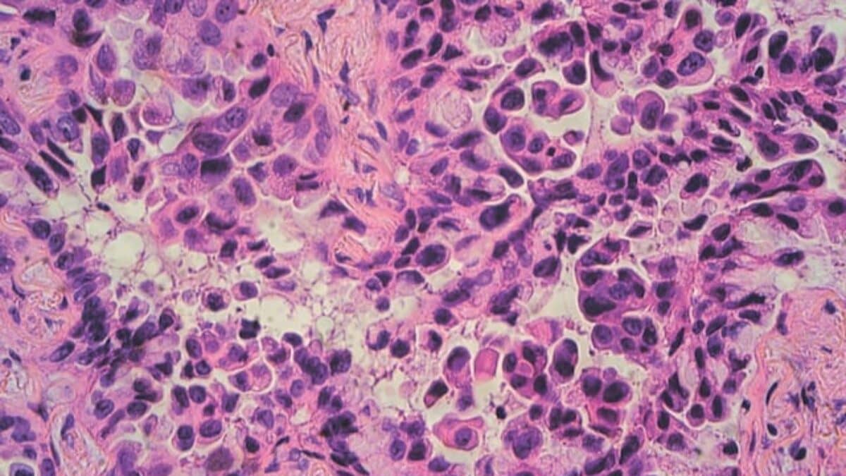 Lung-Cancer2-1200x675.jpg