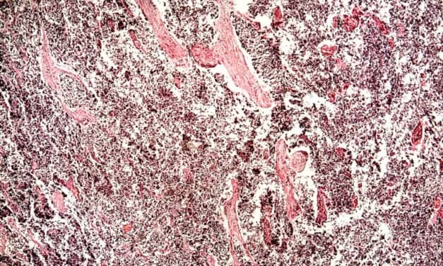 Biodesix Test Identifies Patients with Likely Improved Survival on Afatinib Therapy