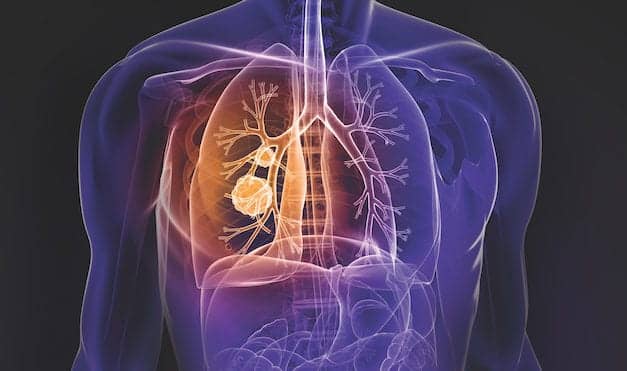 Overcoming Immune Blockade in Non-Small Cell Lung Cancer