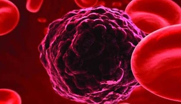 Precipio Launches Liquid Biopsy DNA Enrichment Sales in Europe