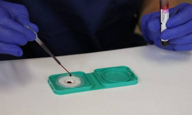 Multivariate Blood Test Can Predict Outcomes for Non-Small Cell Lung Cancer