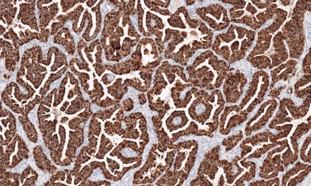 Immunohistochemistry Test Detects ROS1 Protein in Cancer
