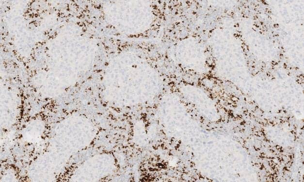 Roche Launches Companion Diagnostic to Identify Triple-Negative Breast Cancer Patients Eligible for Treatment with Tecentriq