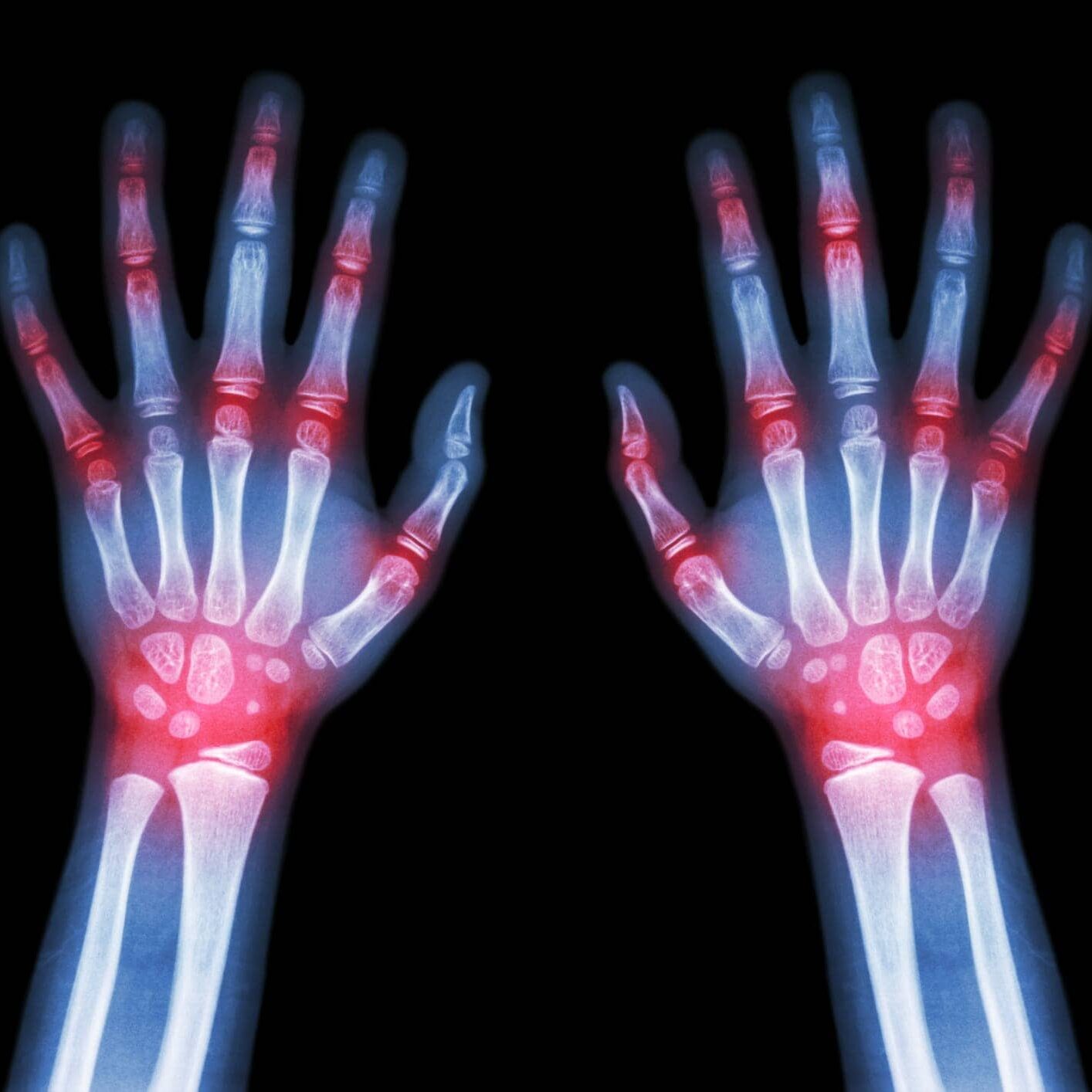 Rheumatoid arthritis