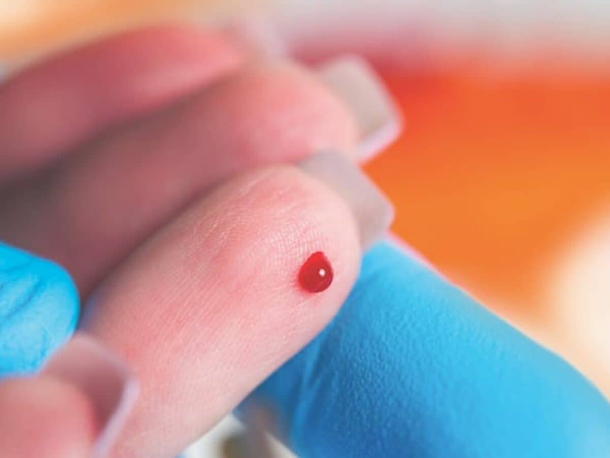 at-home finger-prick glutathione test How to track the finger prick tests sites with Diabetes:M? main image 0