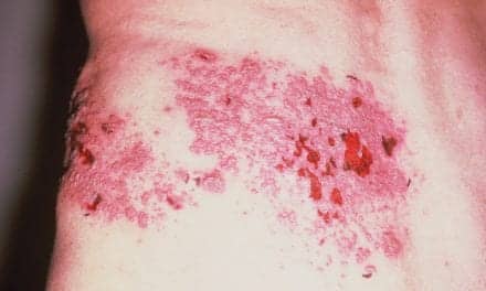 Detecting Varicella-Zoster Virus