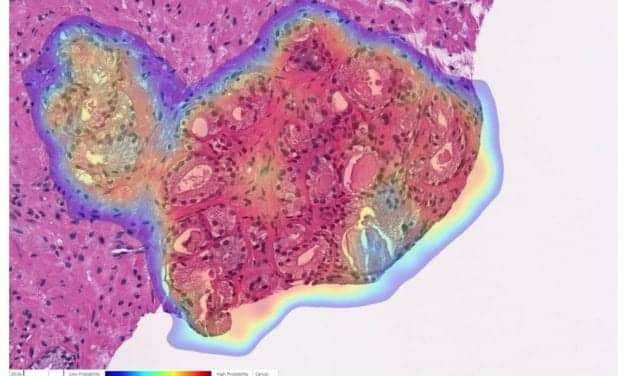 Indica Labs, Ibex Partner on AI Clinical Workflows to Improve Cancer Diagnosis
