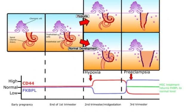 Novel Biomarker Discovery Could Lead to Early Diagnosis of Preeclampsia