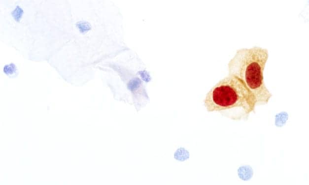 FDA Approves Expanded Use of CINtec Plus Cytology