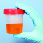 Urine Test Could Help Assess Aspects of Cystic Fibrosis