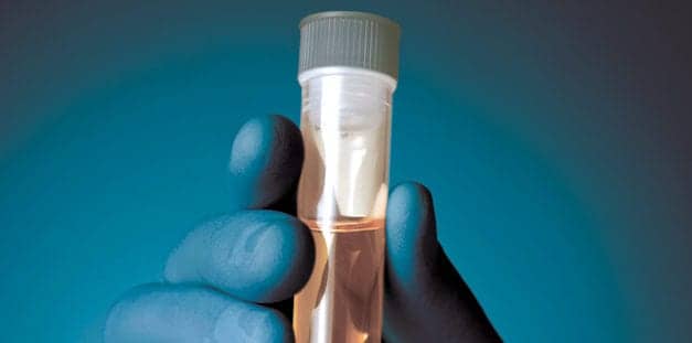 Molecules in Urine Could Allow Doctors to Monitor Skin Cancer