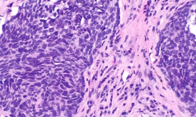 Thermo Fisher, Hengrui Therapeutics to Develop CDx for NSCLC