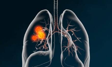 BioAffinity Automated Flow Cytometry Test Detects Lung Cancer in Sputum