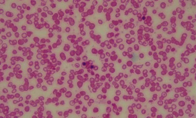 PerkinElmer and American Society of Hematology Collaborate to Combat SCD
