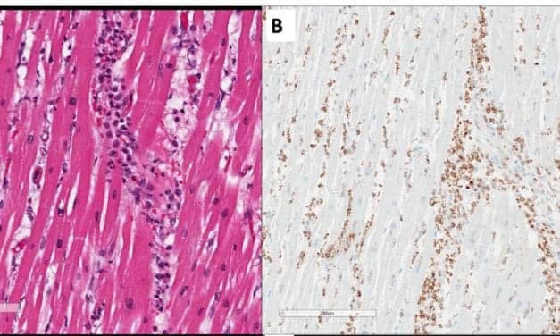 First Pathology Report on Likely Covid-19 MIS Involving the Heart