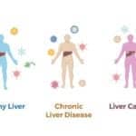 NIH Scientists Develop Blood Test to Help Improve Liver Cancer Screening