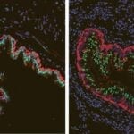 Molecular Analysis Identifies Key Differences in Lungs of Cystic Fibrosis Patients