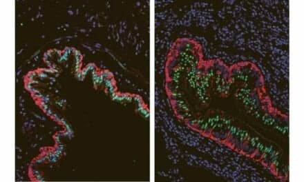 Molecular Analysis Identifies Key Differences in Lungs of Cystic Fibrosis Patients