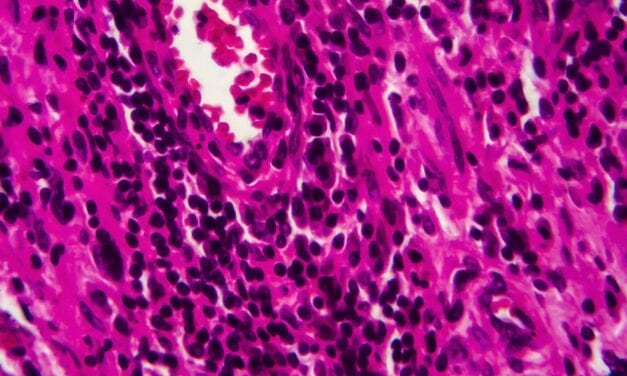 Birmingham University, Nonacus Partner to Develop Urine Test for Bladder Cancer