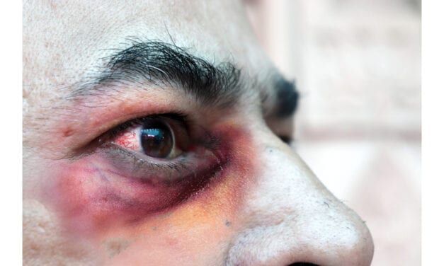 Mucormycosis Early Detection Needed during COVID-19