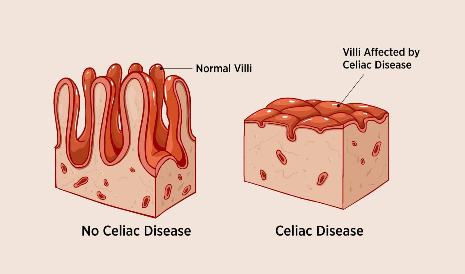 beyond-the-biopsy-serological-testing-offers-greater-diagnosis