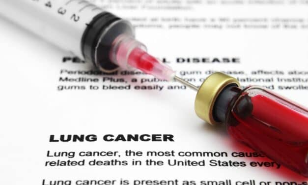 New Liquid Biopsy for Lung Cancer Has High Detection Rate