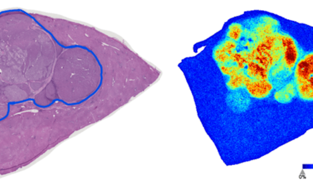 Sugar Structures Could Identify Early-Stage Liver Cancer