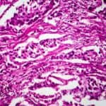 Sequencing Test May Help Determine if Certain Bladder Cancer Patients Need Surgery