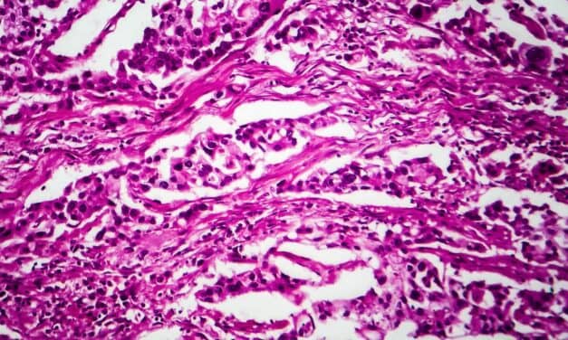 Nanostics Launches Study to Identify Potent Disease Predictors for Early Bladder Cancer Detection
