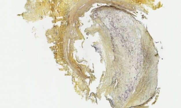 Blood Marker Could Help ID Peripheral Artery Disease Risk