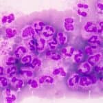 Partnership Aims to Combat Hospital Sepsis Using Precision Diagnostics