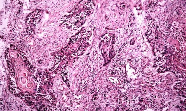 Nasal Swab Test Can Improve Early Lung Cancer Assessment
