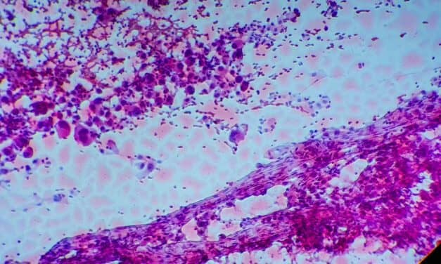 FDA Approves Thermo Fisher’s Test to Identify Therapies for Non-Small Cell Lung Cancer Patients