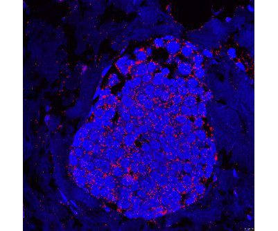 Novel Biomarkers Help Decode Metastatic Breast Cancer