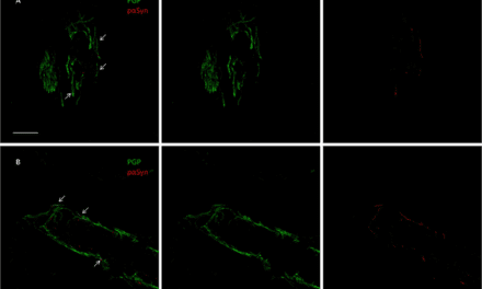 Skin Biopsy Can Help Identify patients with Parkinson’s Disease