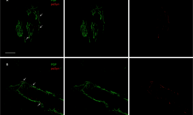 Skin Biopsy Can Help Identify patients with Parkinson’s Disease