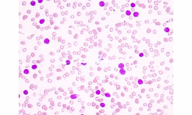 QIAGEN and Servier Will Develop CDx for Acute Myeloid Leukemia Therapy Drug