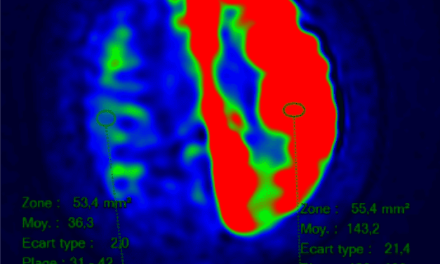 Novel Mutation Associated with Alternating Hemiplegia of Childhood Discovered
