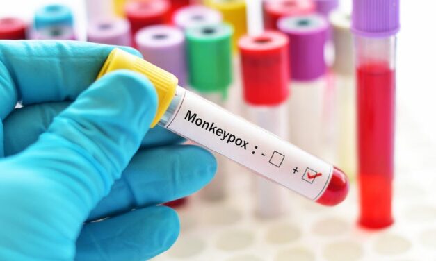 Chembio Diagnostics Evaluates Monkeypox Rapid POC Test Development