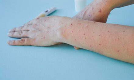 FDA: For Monkeypox Testing, Use Lesion Swab Samples