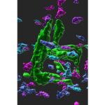 Blood Marker May Predict Risk of Osteoporotic Hip Fracture