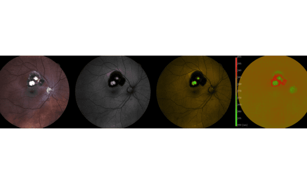New Diagnostic Option for Rare Eye Disease