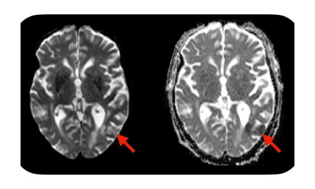 Simple Blood Test Predicts Neurotoxic Complications of CAR-T Cell Therapy