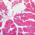 FDA Approves Thermo Fisher’s NGS-based CDx Test for RET-Positive Thyroid Cancer