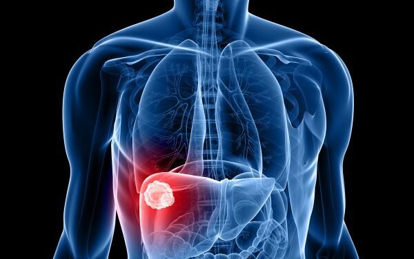 Novel AI Blood Test Detects Liver Cancer