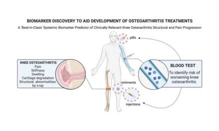 New Blood Test is More Accurate in Identifying Osteoarthritis Progression