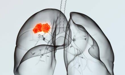 New Epigenomic Technology Platform Predicts Immunotherapy Response in NSCLC Patients